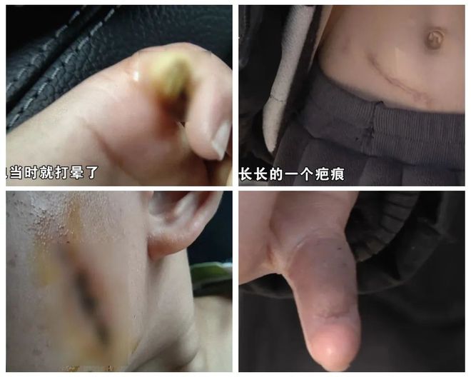 ！5岁儿童爬空调外机瞬间晕厥！long8唯一网站肌腱都打断了(图5)